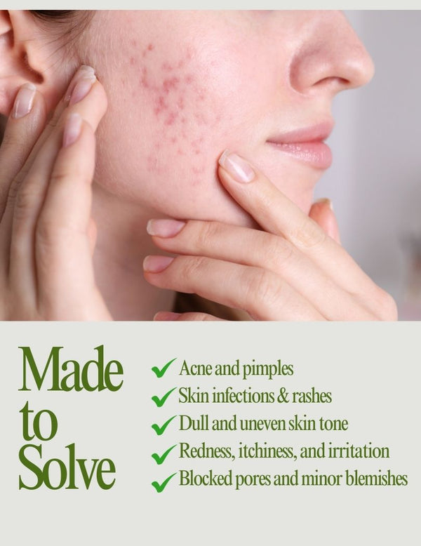 Herbal Soap for Acne-Prone and Oily Skin – Natural Ayurvedic Cleanser